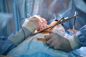 SURGICAL INSTRUMENTS